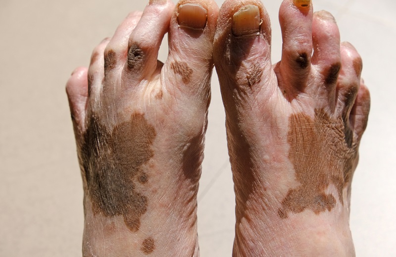 造成白癜风常见的因素有哪些呢 鄂州哪家医院治白癜风专业