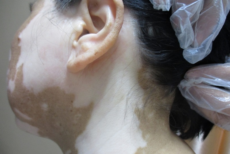 怎样分辨白癜风与皮癣 呼和浩特治疗白癜风哪里好