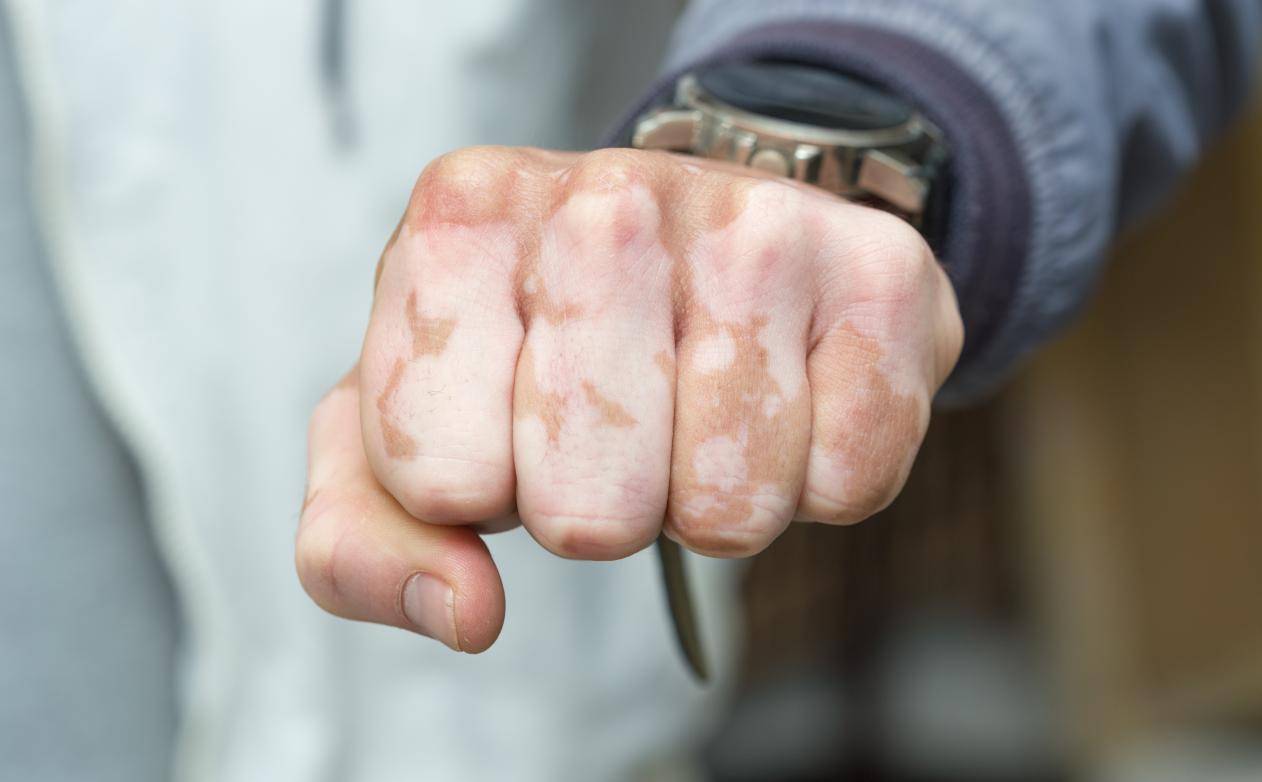 白癜风多久可以康复 白癜风多久可以稳定